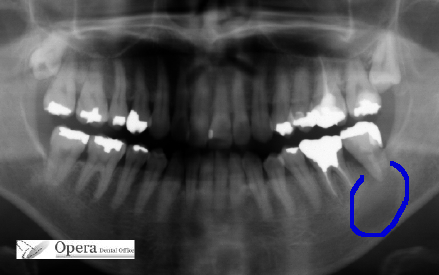 歯の根の先の膿袋 浜松市 歯科オペラデンタル