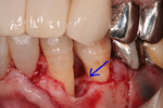 歯科再生療法