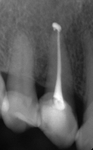 浜松市　歯を残す　歯を抜かない　膿んだ歯　膿袋　根管治療