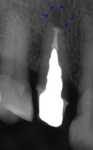 浜松市　歯を残す　歯を抜かない　膿んだ歯　膿袋　根管治療